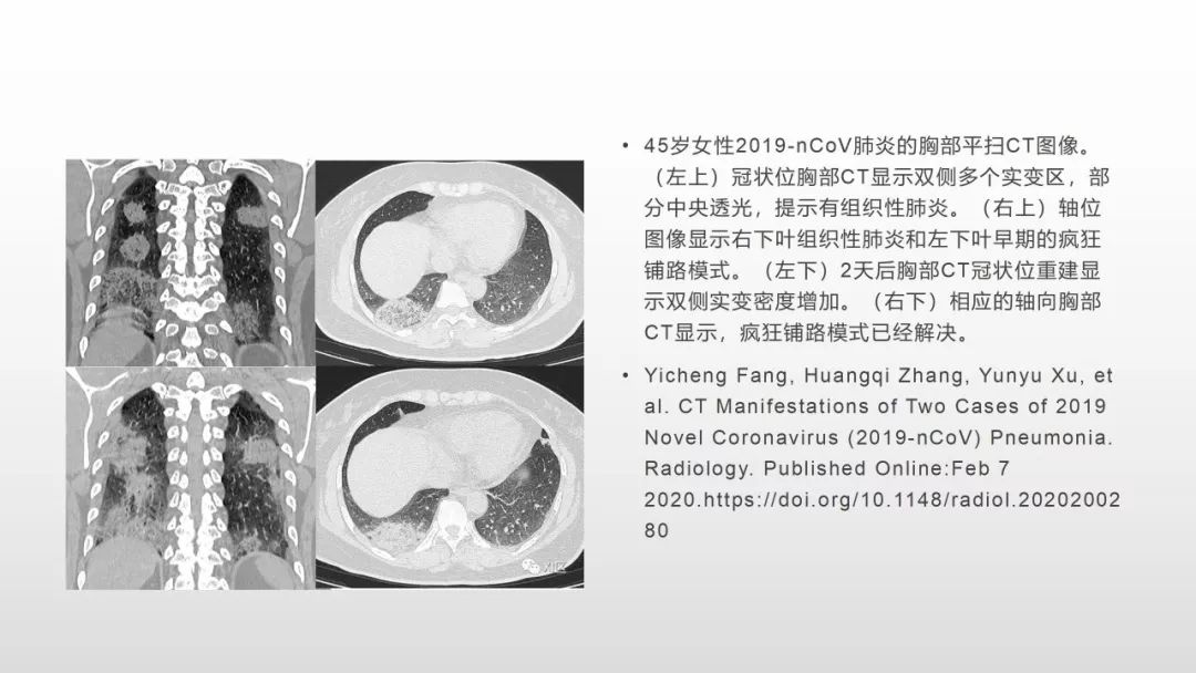 影像病理——COVID-19新型冠状病毒肺炎的“三字经”(附高清病例) 影像病理——COVID-19新型冠状病毒肺炎的“三字经”(附高清病例)