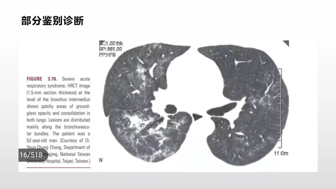 影像病理——COVID-19新型冠状病毒肺炎的“三字经”(附高清病例) 影像病理——COVID-19新型冠状病毒肺炎的“三字经”(附高清病例)
