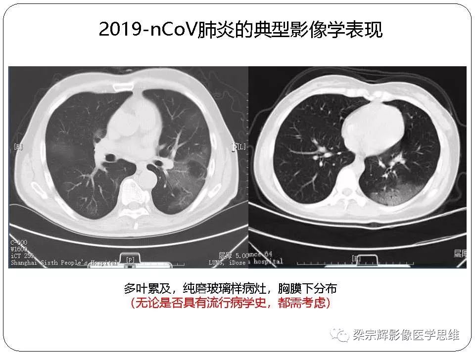 【PPT】新型冠状病毒肺炎影像学诊断与鉴别：心血管病医师需知
