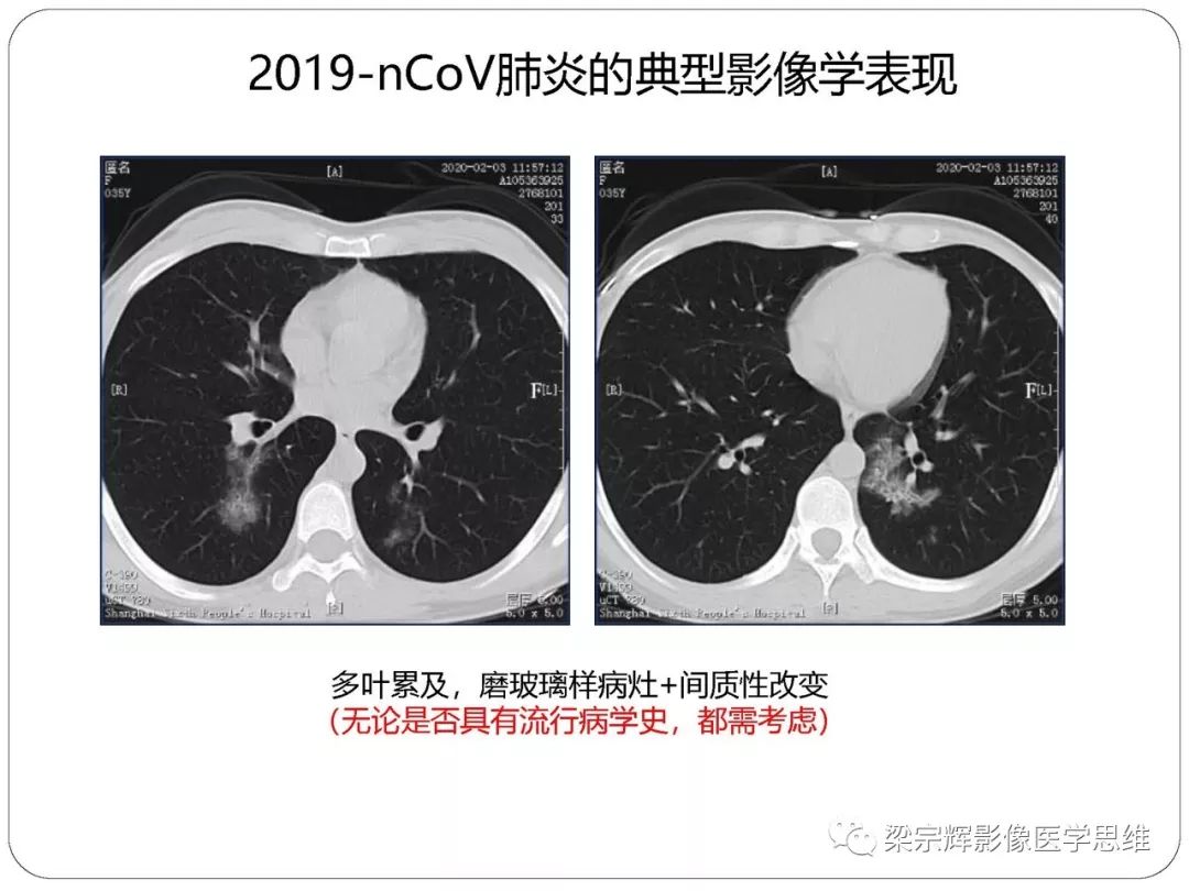 【PPT】新型冠状病毒肺炎影像学诊断与鉴别：心血管病医师需知