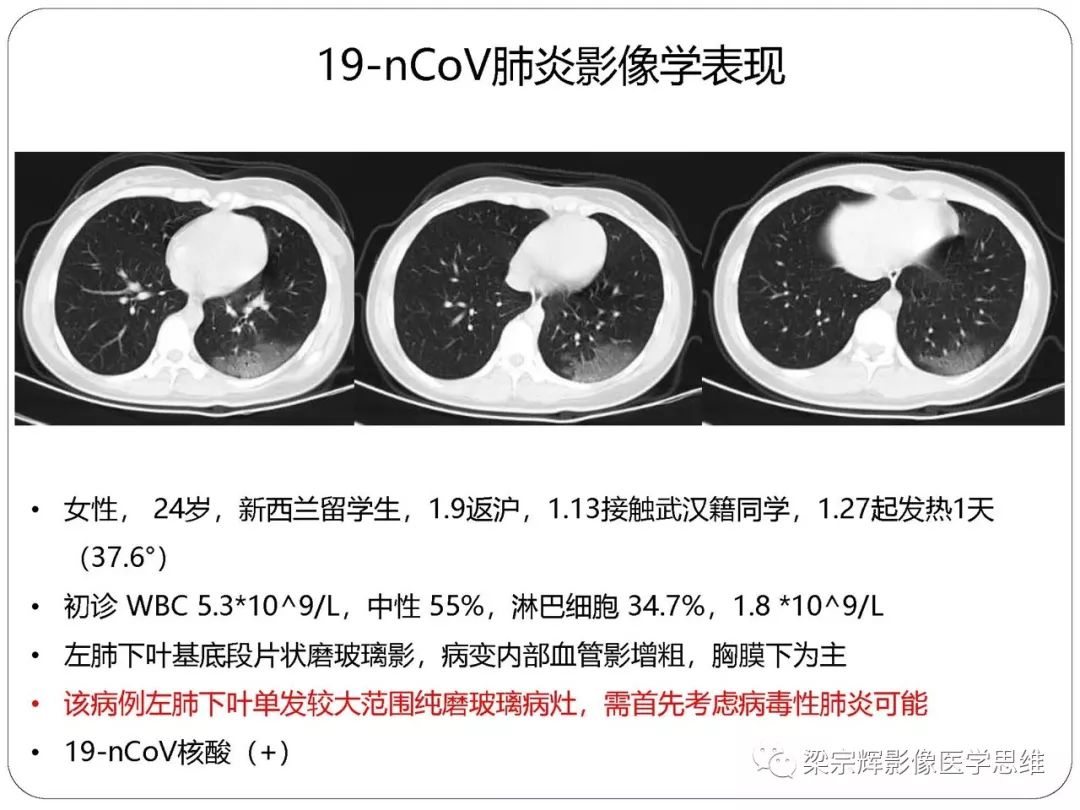 【PPT】新型冠状病毒肺炎影像学诊断与鉴别：心血管病医师需知