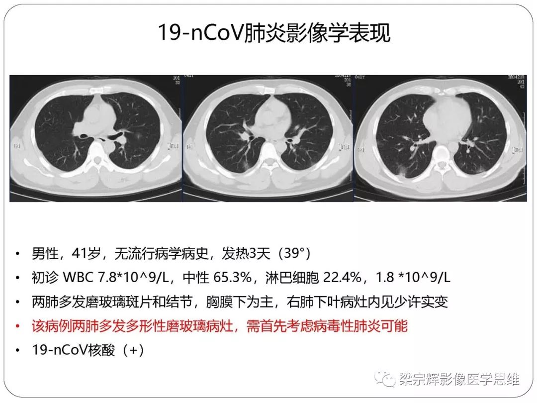 【PPT】新型冠状病毒肺炎影像学诊断与鉴别：心血管病医师需知