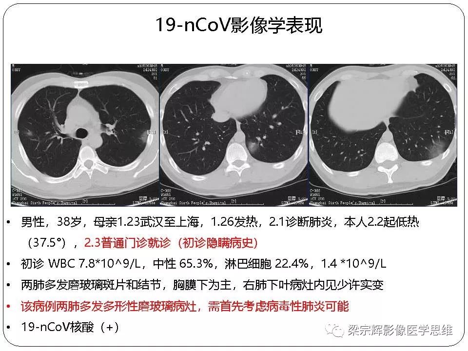 【PPT】新型冠状病毒肺炎影像学诊断与鉴别：心血管病医师需知