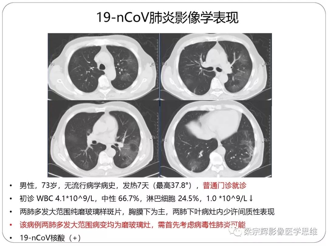 【PPT】新型冠状病毒肺炎影像学诊断与鉴别：心血管病医师需知