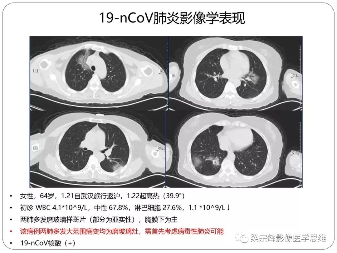 【PPT】新型冠状病毒肺炎影像学诊断与鉴别：心血管病医师需知