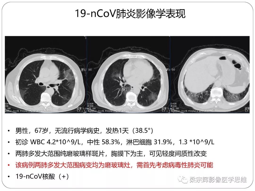 【PPT】新型冠状病毒肺炎影像学诊断与鉴别：心血管病医师需知
