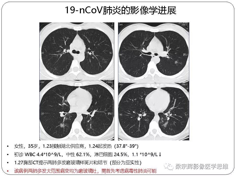 【PPT】新型冠状病毒肺炎影像学诊断与鉴别：心血管病医师需知