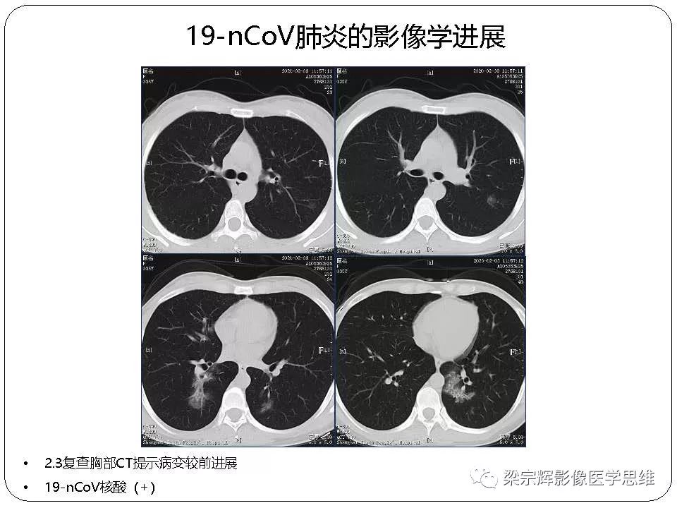 【PPT】新型冠状病毒肺炎影像学诊断与鉴别：心血管病医师需知