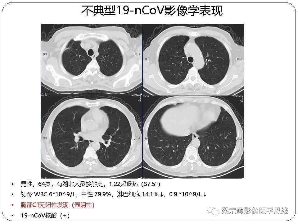 【PPT】新型冠状病毒肺炎影像学诊断与鉴别：心血管病医师需知