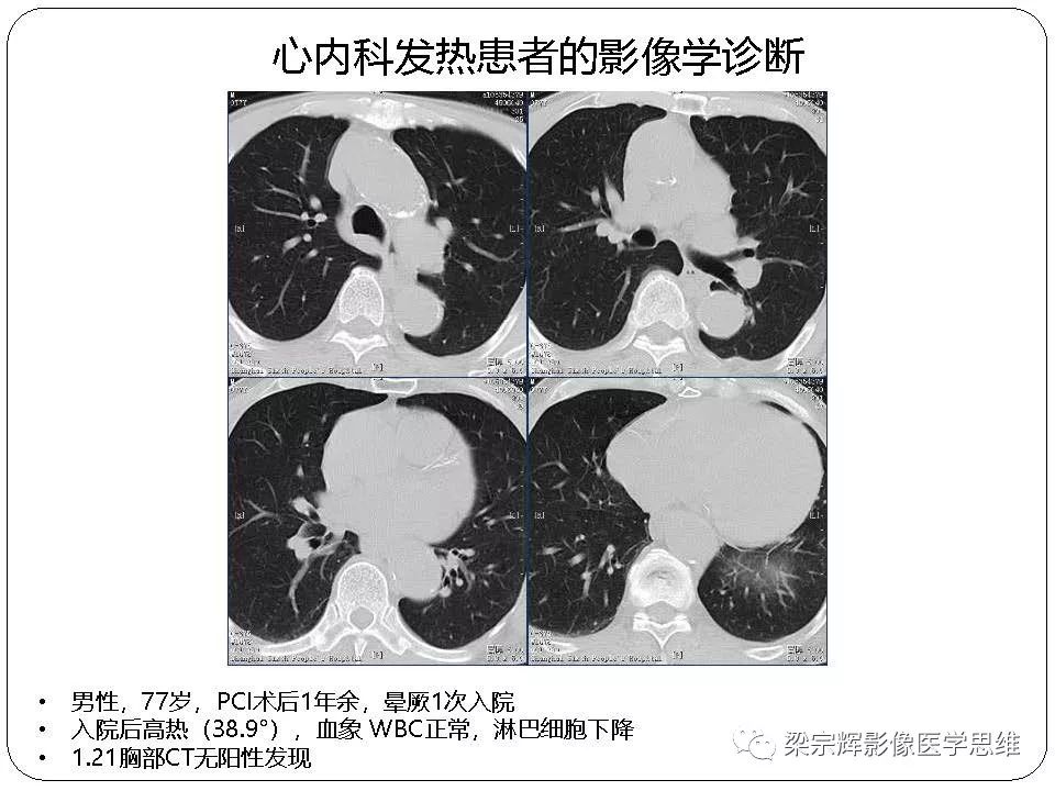 【PPT】新型冠状病毒肺炎影像学诊断与鉴别：心血管病医师需知