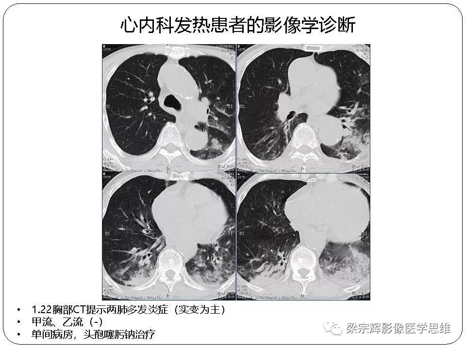 【PPT】新型冠状病毒肺炎影像学诊断与鉴别：心血管病医师需知