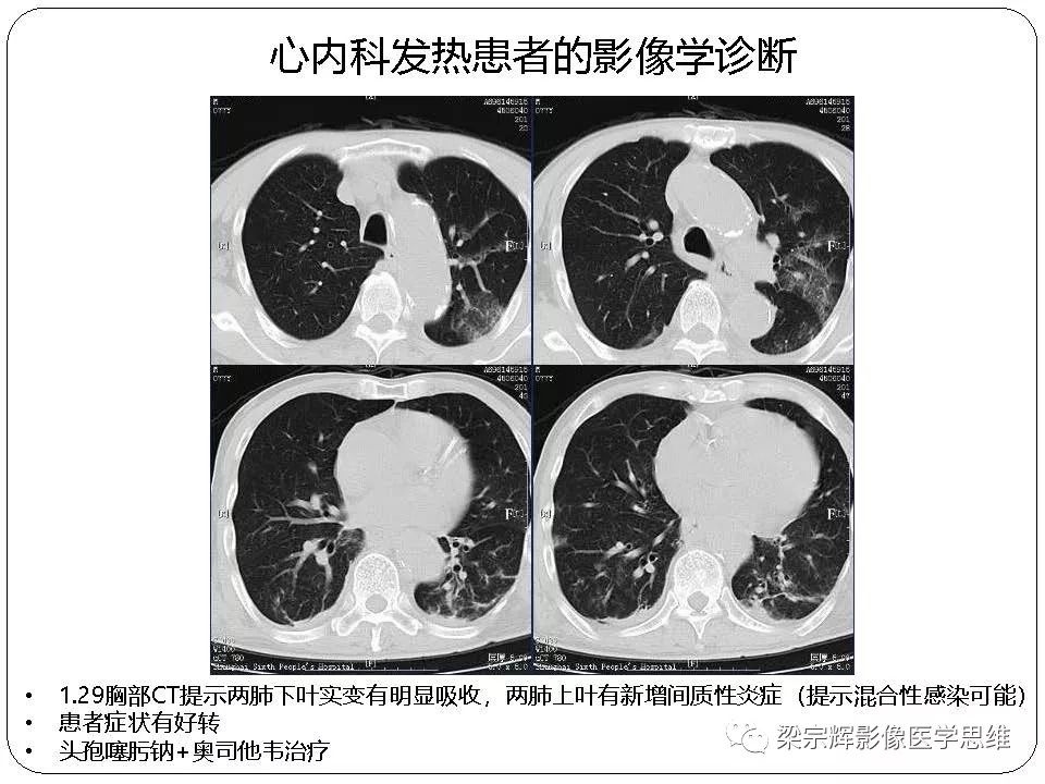 【PPT】新型冠状病毒肺炎影像学诊断与鉴别：心血管病医师需知