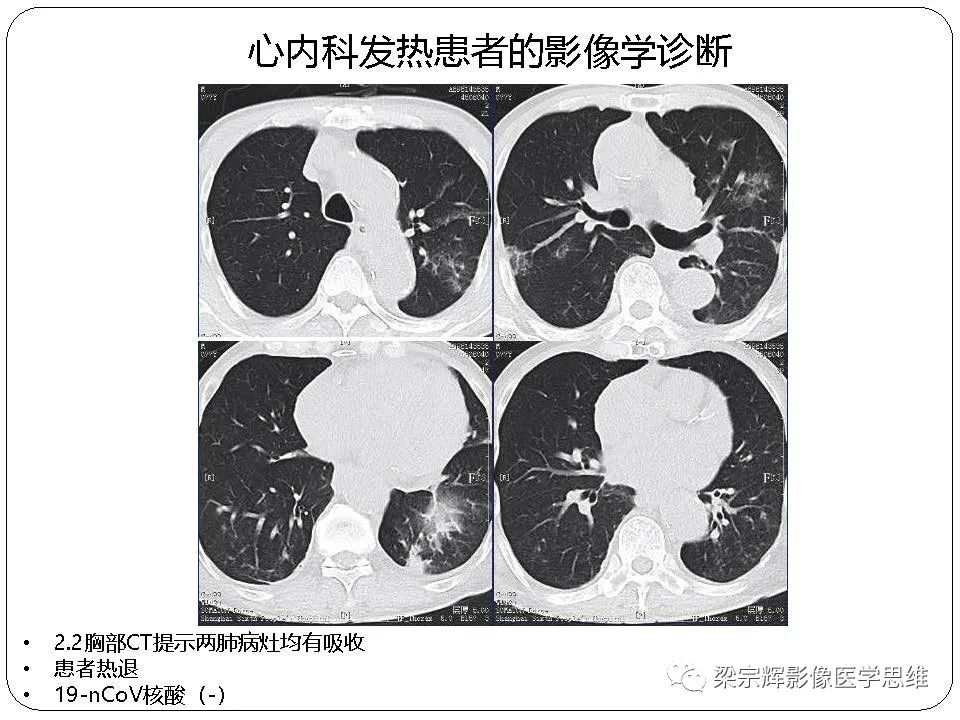 【PPT】新型冠状病毒肺炎影像学诊断与鉴别：心血管病医师需知