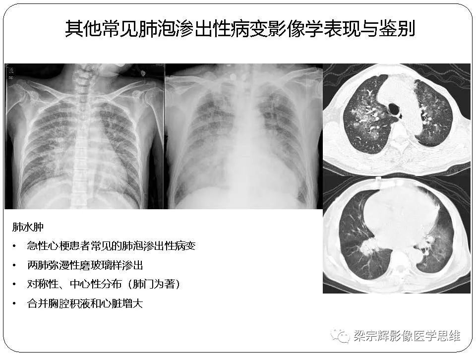【PPT】新型冠状病毒肺炎影像学诊断与鉴别：心血管病医师需知