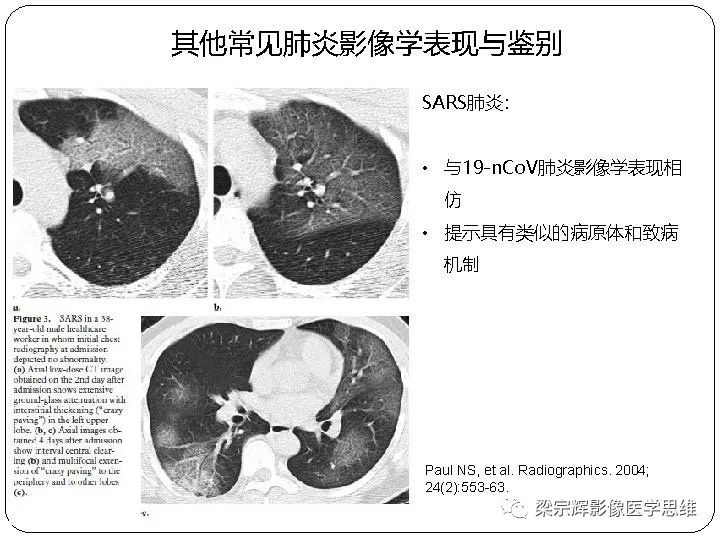 【PPT】新型冠状病毒肺炎影像学诊断与鉴别：心血管病医师需知