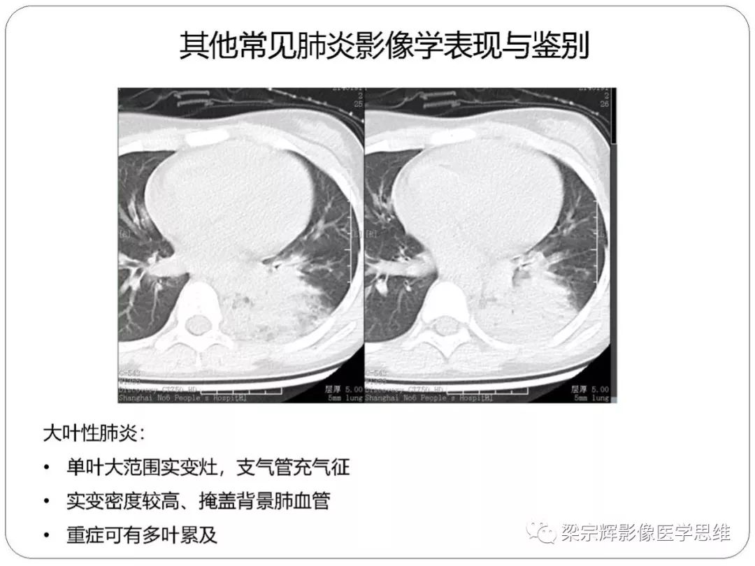 【PPT】新型冠状病毒肺炎影像学诊断与鉴别：心血管病医师需知