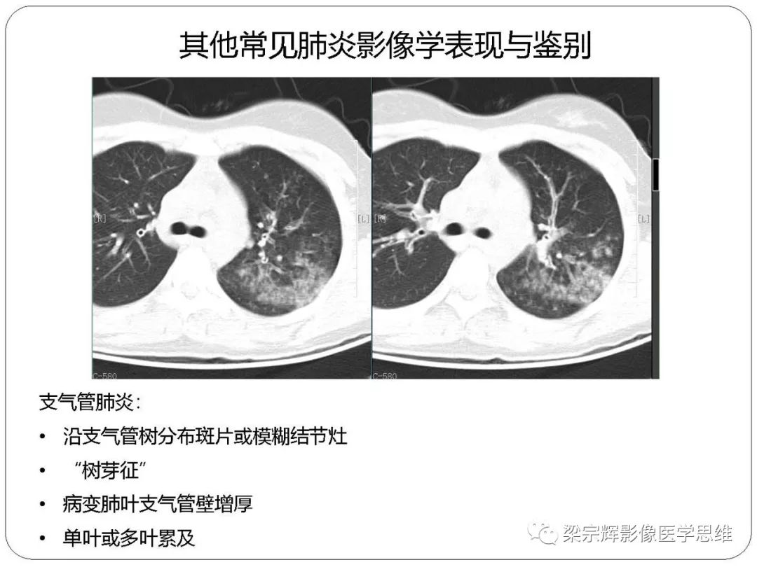 【PPT】新型冠状病毒肺炎影像学诊断与鉴别：心血管病医师需知