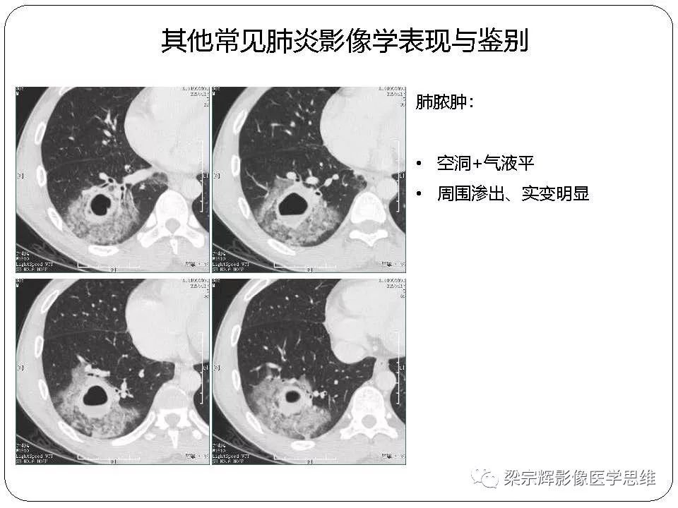 【PPT】新型冠状病毒肺炎影像学诊断与鉴别：心血管病医师需知