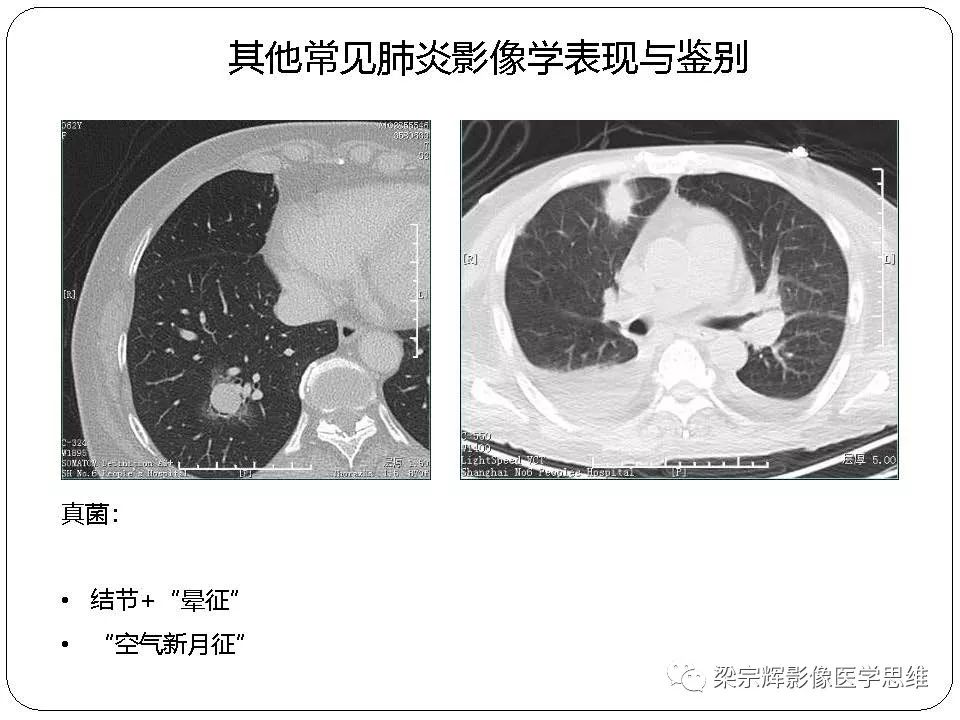 【PPT】新型冠状病毒肺炎影像学诊断与鉴别：心血管病医师需知