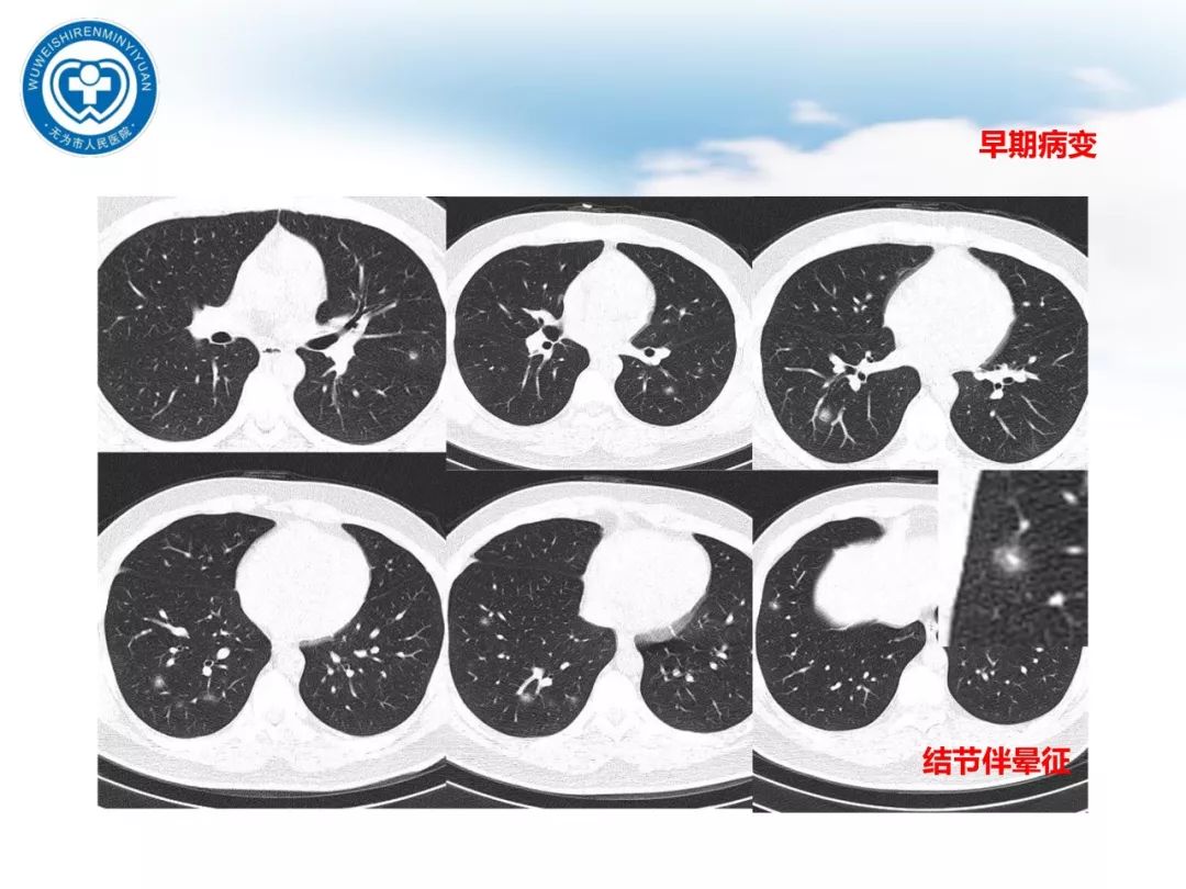 【PPT】新型冠状病毒肺炎影像学病例汇报