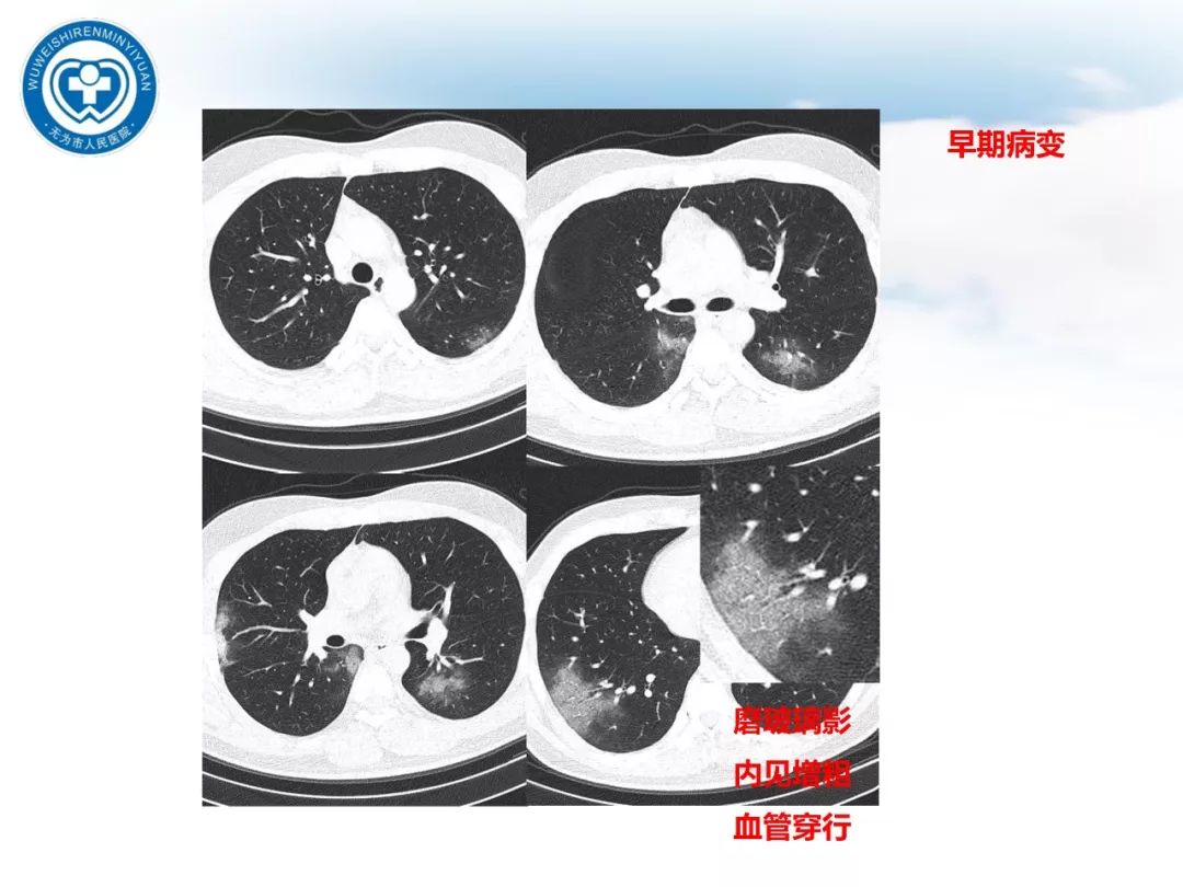【PPT】新型冠状病毒肺炎影像学病例汇报