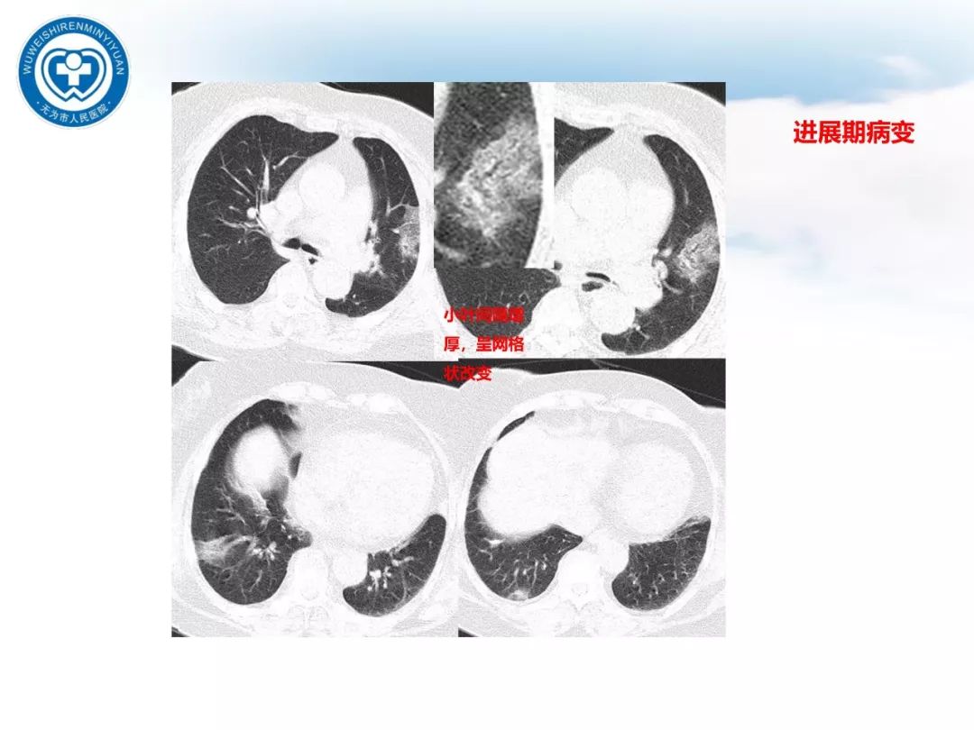 【PPT】新型冠状病毒肺炎影像学病例汇报