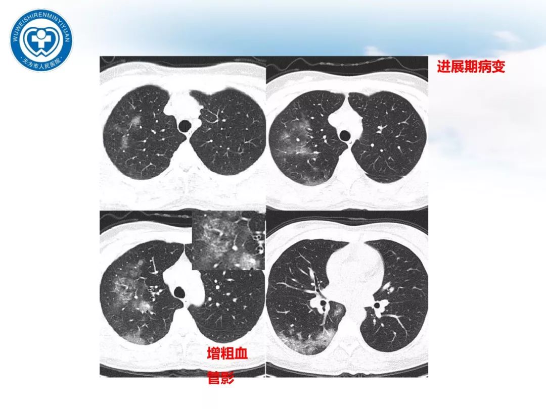 【PPT】新型冠状病毒肺炎影像学病例汇报