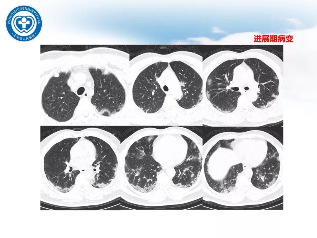 【PPT】新型冠状病毒肺炎影像学病例汇报