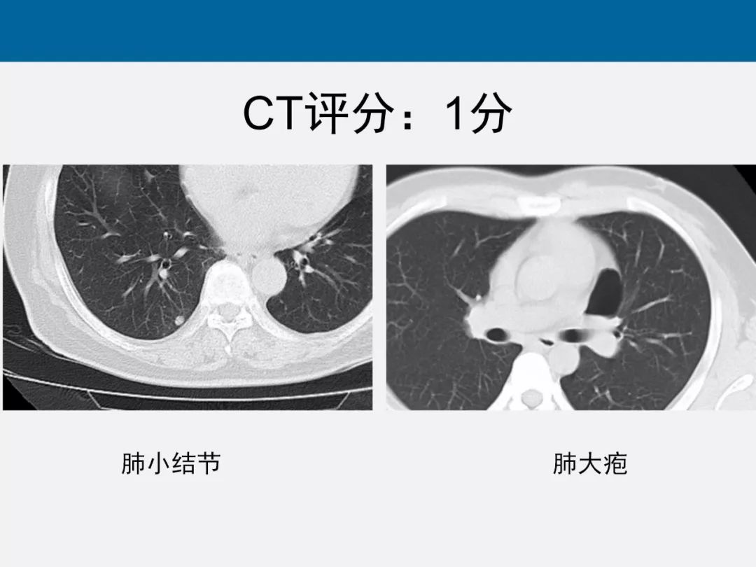 【PPT】新型冠状病毒肺炎CT评分及应用