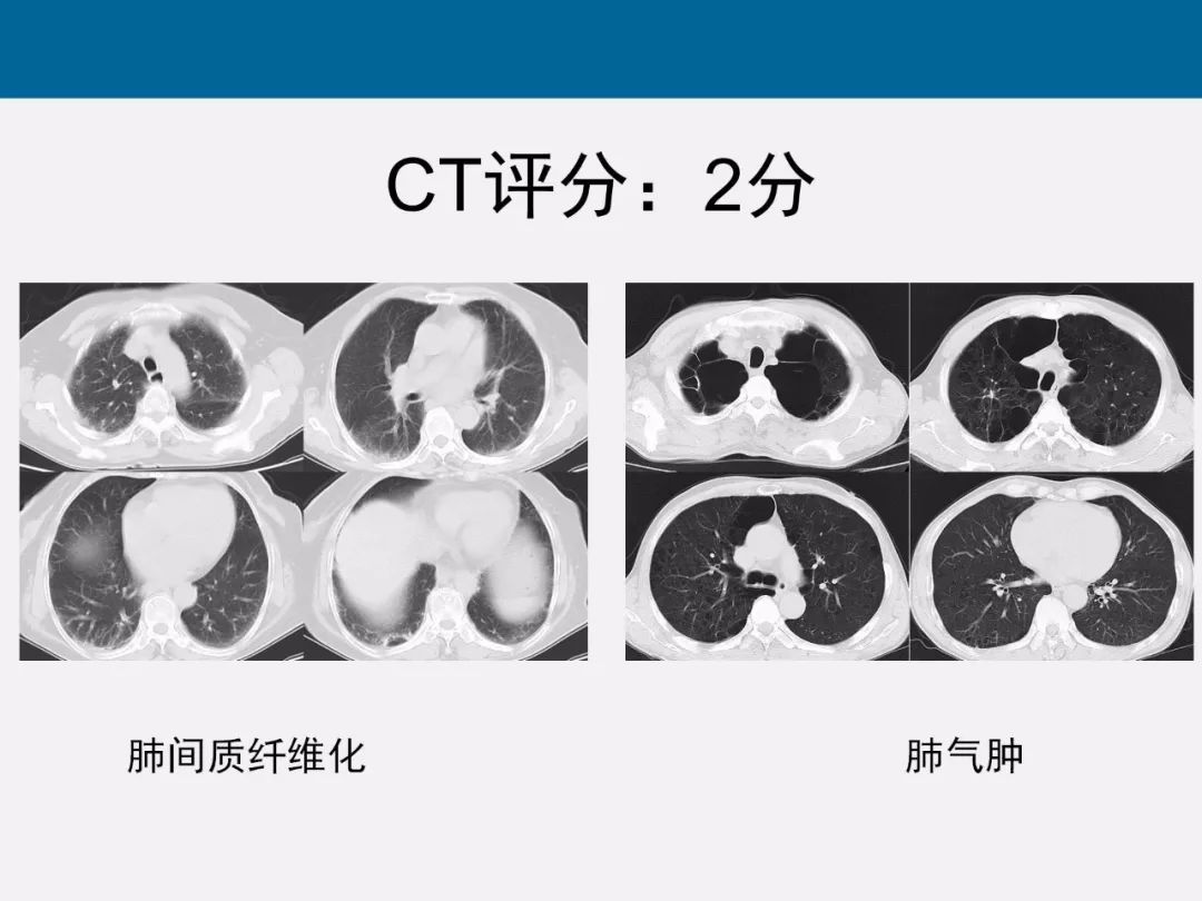 【PPT】新型冠状病毒肺炎CT评分及应用