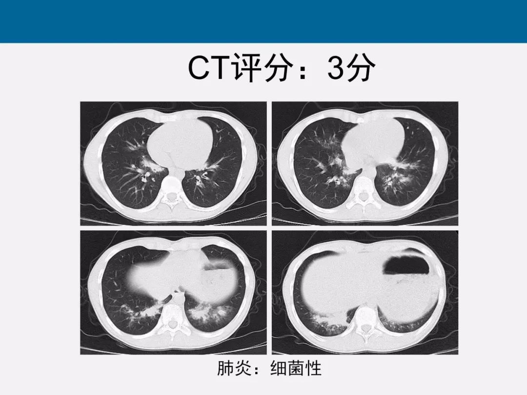 【PPT】新型冠状病毒肺炎CT评分及应用