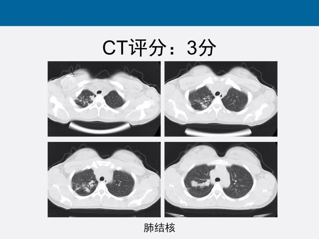 【PPT】新型冠状病毒肺炎CT评分及应用