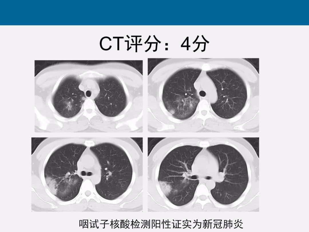 【PPT】新型冠状病毒肺炎CT评分及应用