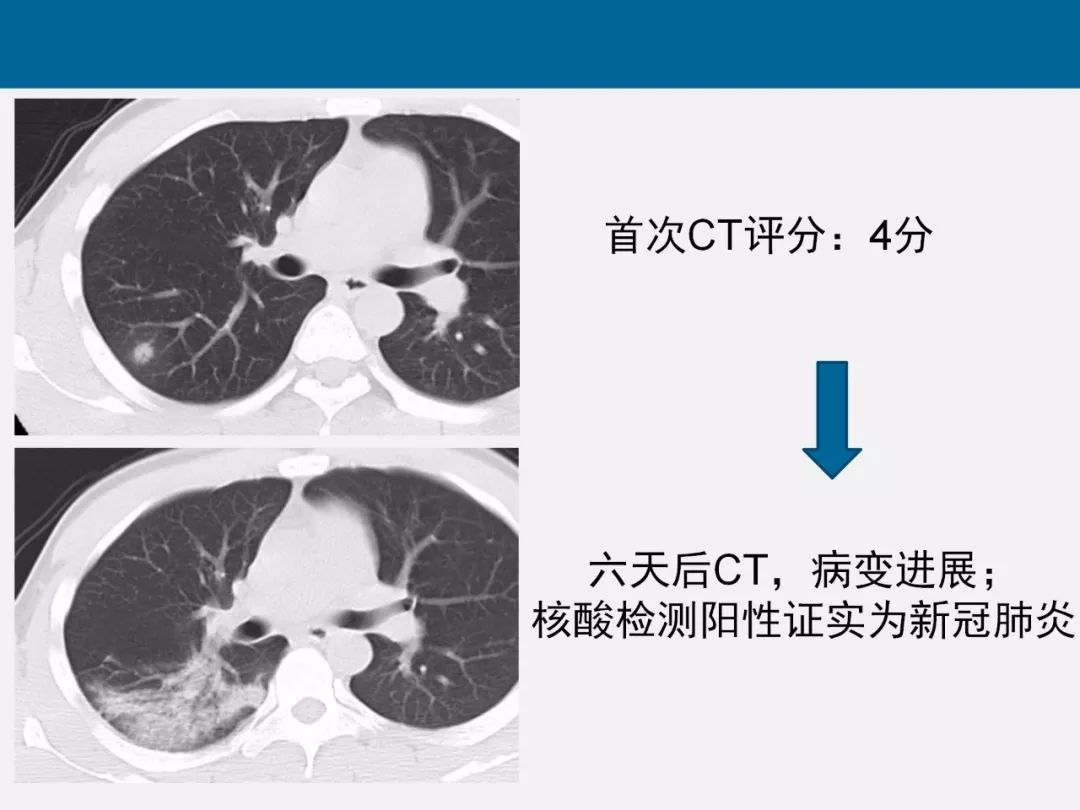 【PPT】新型冠状病毒肺炎CT评分及应用