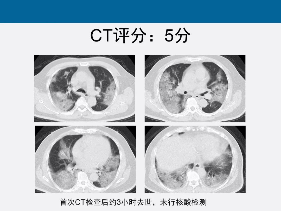 【PPT】新型冠状病毒肺炎CT评分及应用