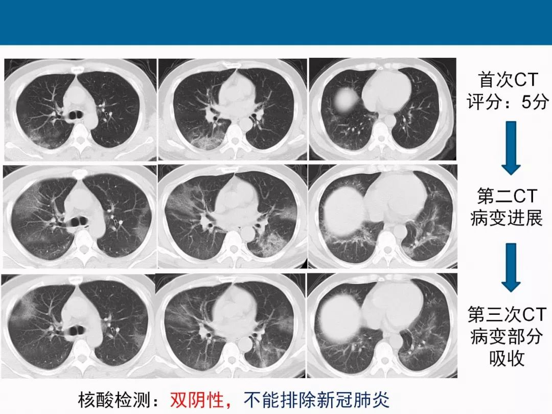 【PPT】新型冠状病毒肺炎CT评分及应用