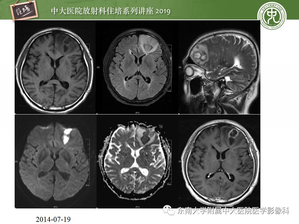【PPT】脑脓肿的诊断与鉴别