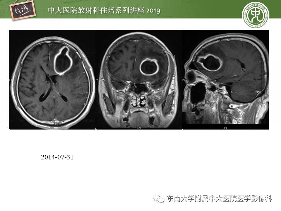【PPT】脑脓肿的诊断与鉴别