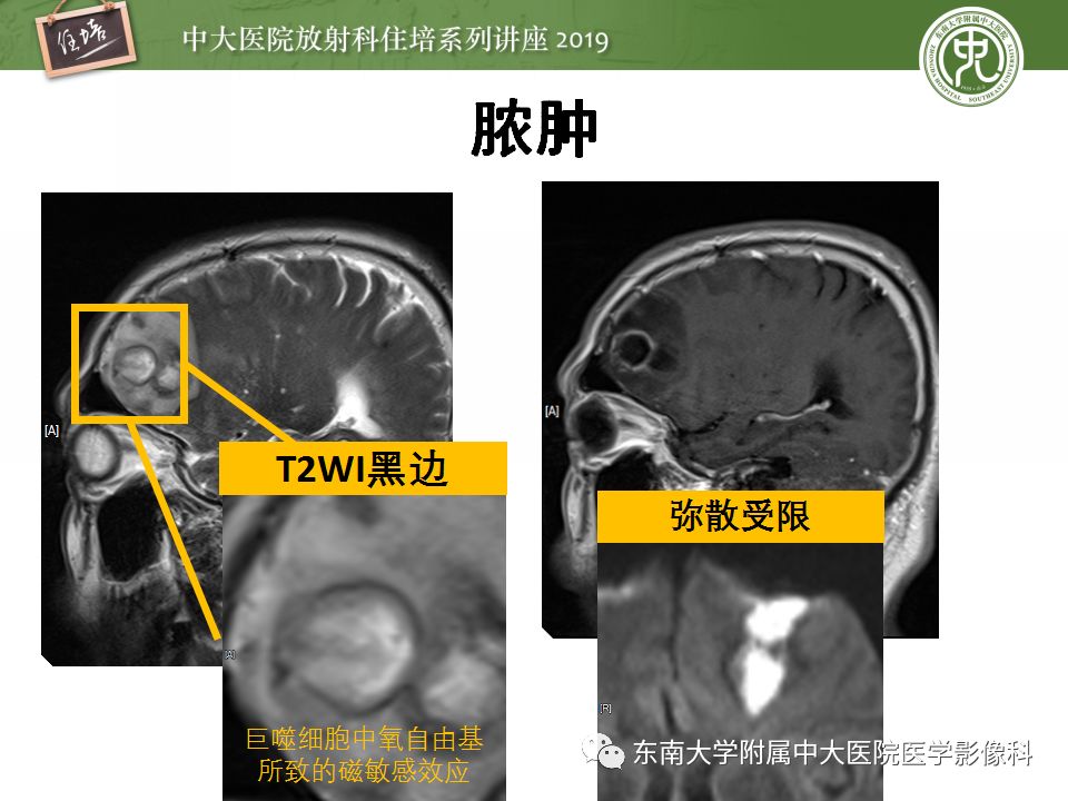 【PPT】脑脓肿的诊断与鉴别