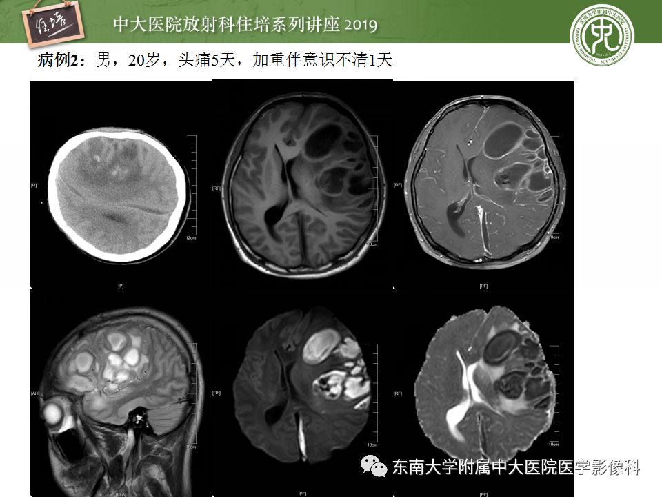 【PPT】脑脓肿的诊断与鉴别