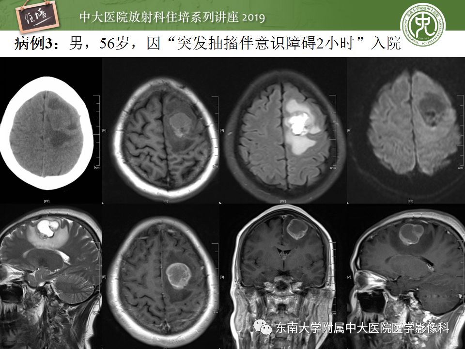 【PPT】脑脓肿的诊断与鉴别
