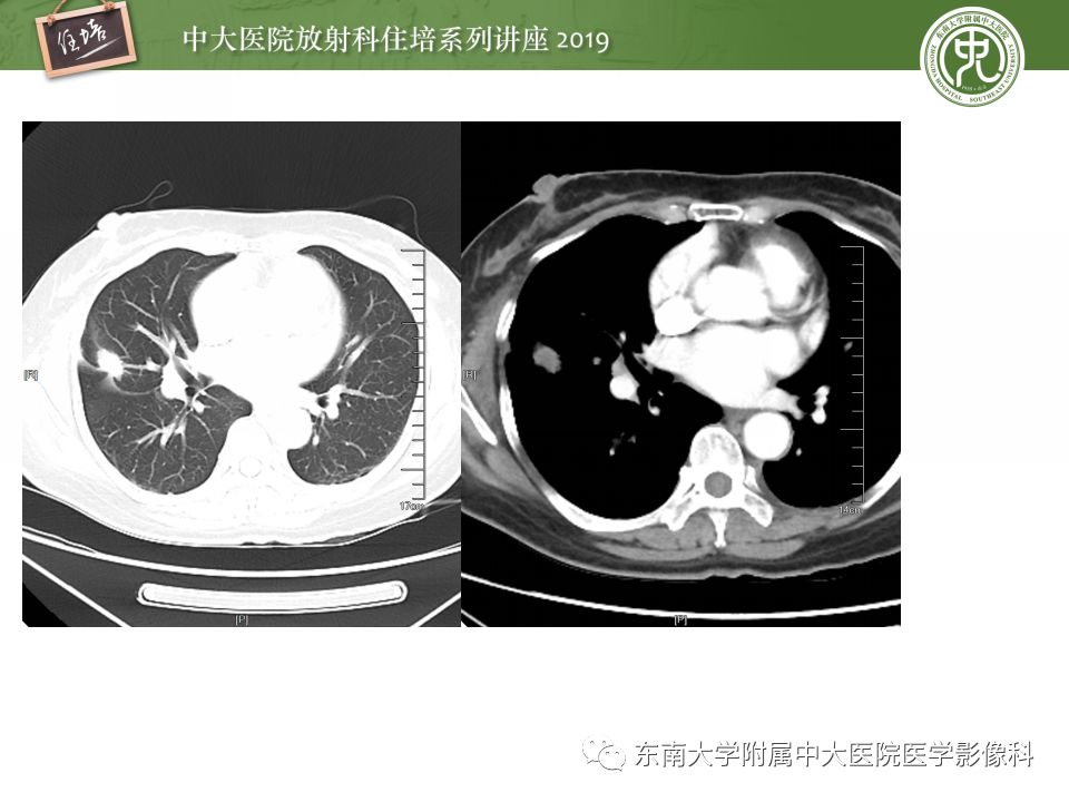 【PPT】脑脓肿的诊断与鉴别