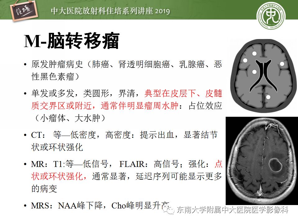 【PPT】脑脓肿的诊断与鉴别