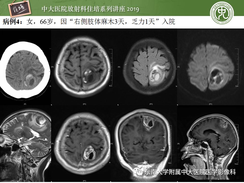 【PPT】脑脓肿的诊断与鉴别