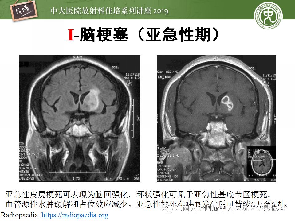 【PPT】脑脓肿的诊断与鉴别