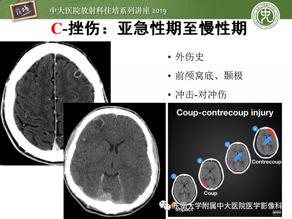 【PPT】脑脓肿的诊断与鉴别