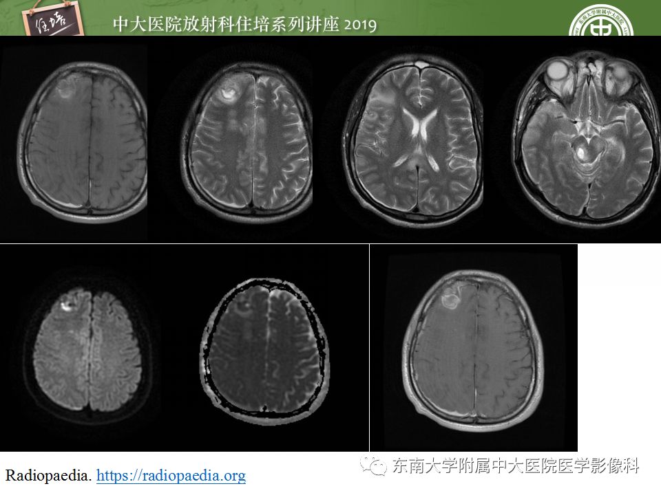 【PPT】脑脓肿的诊断与鉴别