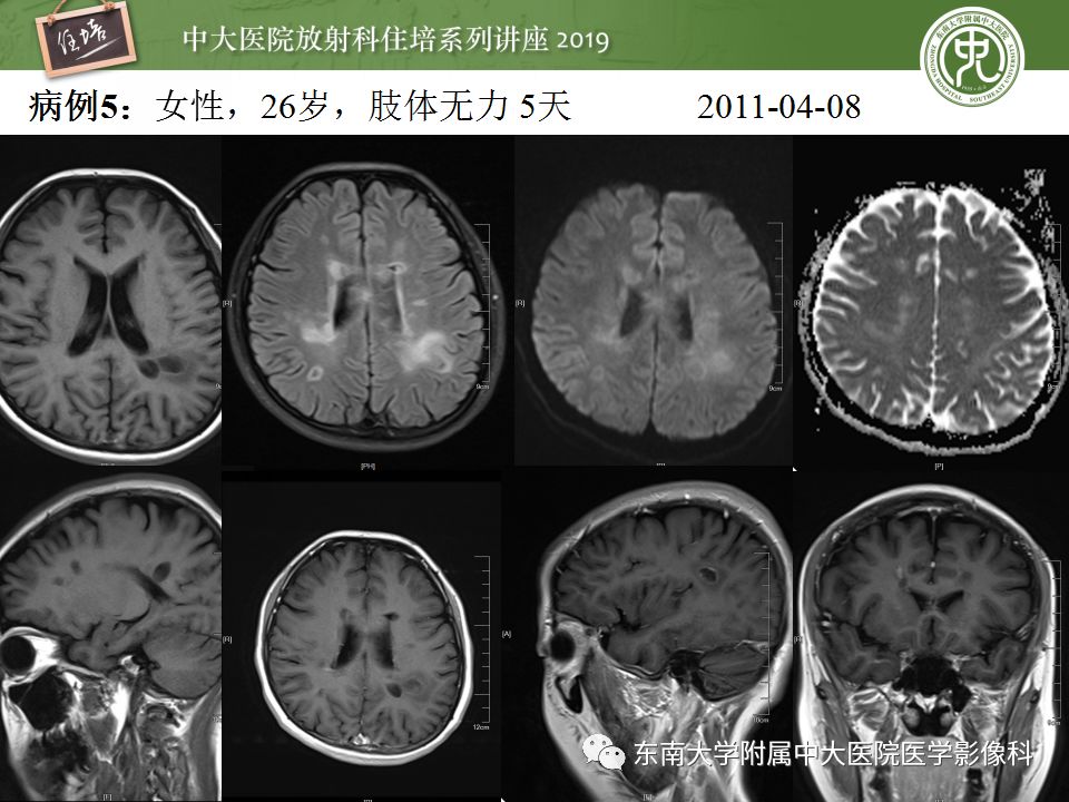 【PPT】脑脓肿的诊断与鉴别