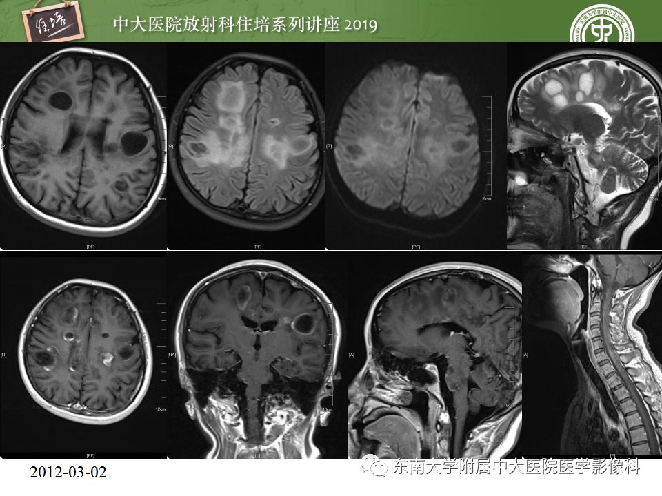 【PPT】脑脓肿的诊断与鉴别