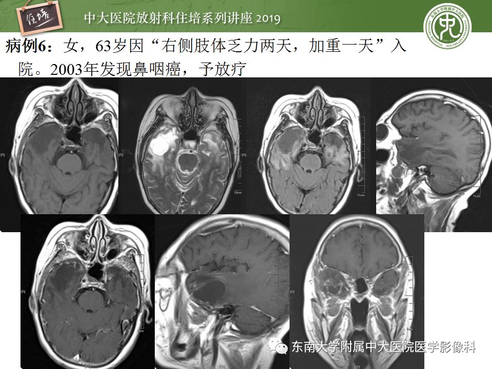 【PPT】脑脓肿的诊断与鉴别